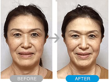 ワト(WATO)/■小顔施術(before→after)