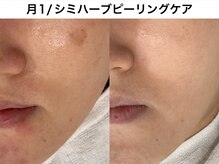 トリニエンス 南流山店/30代/シミケア/肌改善/美白