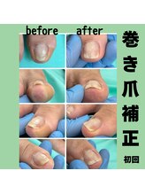 巻き爪補正店 徳重店/巻き爪補正