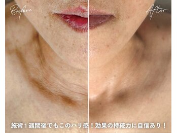 AK エステティックス(AK Esthetics)/首のシワケアもお任せ★プラズマ