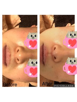 フェリース鍼灸院/美容鍼+ララピール