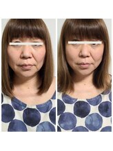 キレイ(KIREI)/ビフォーアフター（カプセル）