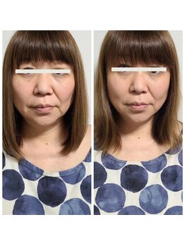 キレイ(KIREI)/ビフォーアフター（カプセル）