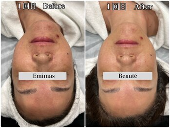 エミマス ボーテ(Emimas Beaute’)/５０代前半　毛穴洗浄＆幹細胞