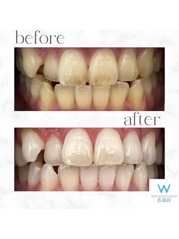 ホワイトニングショップ 広島店(WHITENING SHOP)/【ホワイトニング】Before After