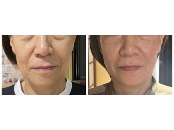 ねこのひげ/お顔の変化