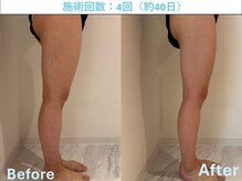 オーダーメイドの痩身メニューで美脚【前橋/リンパ/ダイエット】