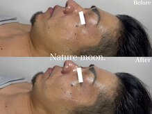 ナチュールムーン(Nature moon.)/ハーブピーリング