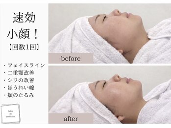 サロン ド パーフェクション(Salon de Perfection)/小顔リフト