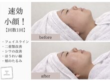 サロン ド パーフェクション(Salon de Perfection)/小顔リフト