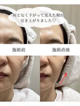 ハジュ(HAJU.)/フォト光フェイシャル