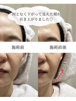 ハジュ(HAJU.)/フォト光フェイシャル