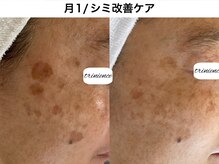 トリニエンス 南流山店/50代/シミケア/パーソナルケア