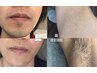 破格!ご新規様【顔全体or脇脱毛】男女利用可能 効果抜群
