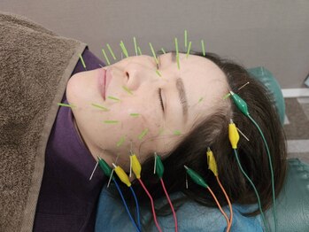越谷マックス鍼灸整骨院の写真/越谷駅徒歩3分*【美容鍼×電流】で深層筋にアプローチ。たるみ改善でリフトアップ効果◎誰もが羨む小顔へ♪