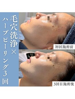 エミーニー(emiiny)/肌荒れの根本を断つ