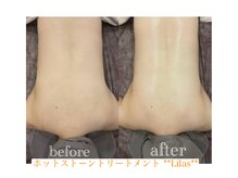 リラ(Lilas)/ホットストーンでゆるめて流す