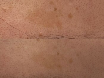 ベアール(beal)/シミ特化ハーブピーリング4回