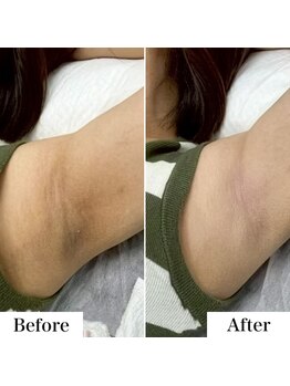 ルネル(Lunelle)/韓国式メラニンケア《脇》