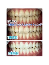 ホワイトニングスタイル 柏店/短期間で白くしたいお客様★