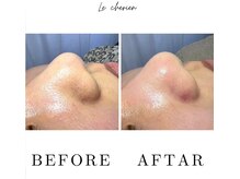 ルシェリア(Le cherien)/ハイドラフェイシャル