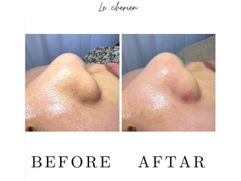 ルシェリア(Le cherien)/ハイドラフェイシャル