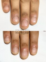 マリーロール 梅田店(Marie Laure)/自爪育成/深爪矯正/ネイルケア