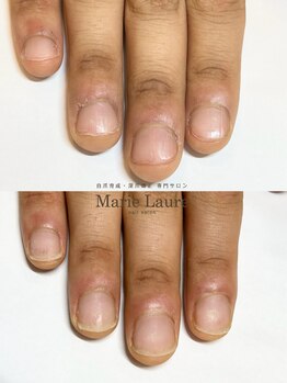 マリーロール 梅田店(Marie Laure)/自爪育成/深爪矯正/ネイルケア