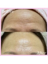 トータルビューティサロン クイーン(Queen)/おでこや目元のシワ