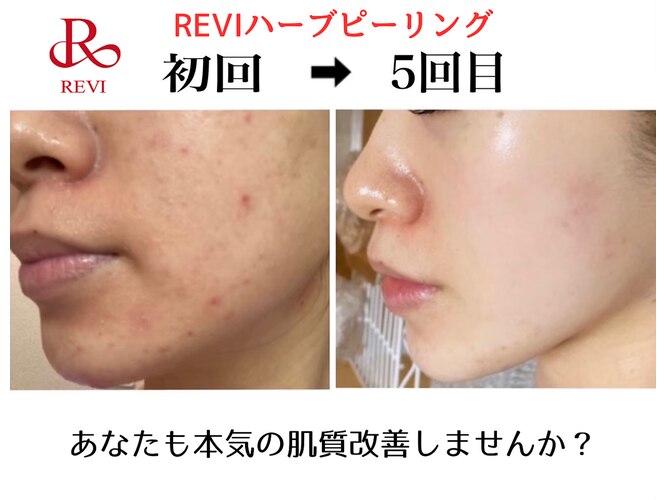 REVIハーブピーリング10回＋エンザイム10 凄かっ