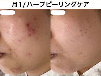 トリニエンス 南流山店/20代/ニキビケア/肌質改善/艶肌