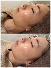 ジェニー(JENNI)/スキンメイド　1回での変化