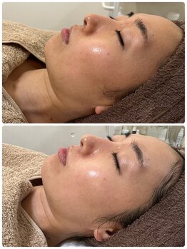 ジェニー(JENNI)/スキンメイド　1回での変化