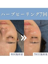 エミーニー(emiiny)/ハーブピーリング7回