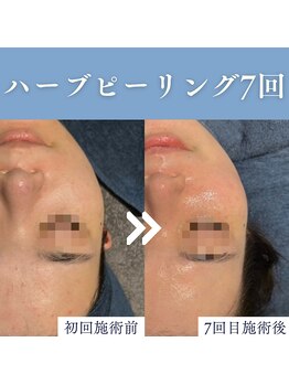 エミーニー(emiiny)/ハーブピーリング7回