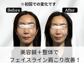 ハリユナイテッド 原宿鍼灸 整体院(HALI UNITED)/美容鍼+整体で小顔、肩こり改善