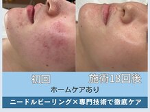 アロマ(AROMA)/赤ニキビケア/毛穴/越谷