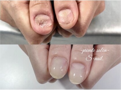 エスネイル(S-nail)の写真