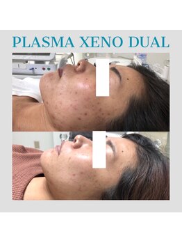 ビーダブリュー(BW...)/☆プラズマゼノデュアル施術例☆