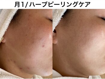 トリニエンス 南流山店/30代/ニキビケア/肌質改善/艶肌