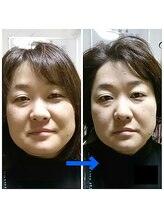 ほっとふらっと 長岡店/小顔矯正ビフォーアフター