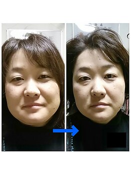 ほっとふらっと 長岡店/小顔矯正ビフォーアフター