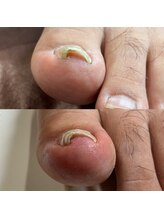 リリ(lili)/巻き爪矯正3回目（左親指）