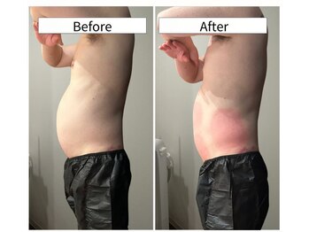 ルキア(LUKIA)/痩身【脂肪冷却】症例６　おなか