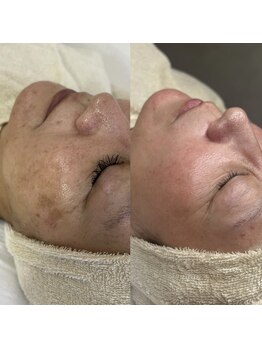 ラヴィ(Ravi)/プロセルフェイシャル