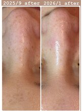 レンリー(Renry)/変わるのは毛穴だけじゃない！？