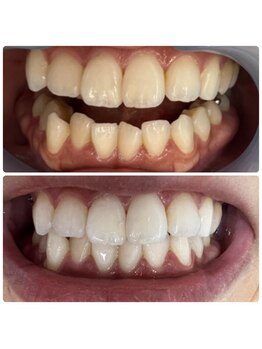 ラブホワイトニング 恵比寿店(LOVEホワイトニング)/【初回限定】2回照射¥980