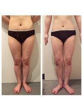 マルロ美容整体院 バイ サロンリーナ(MARLO美容整体院 by Salon Lena)/M様12回で下半身スッキリ