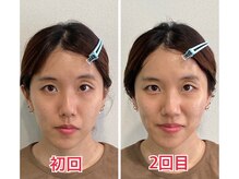 小顔22 ボルティ 赤坂支店(Bolty)/小顔シンメトリー矯正＆全身矯正