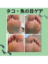 巻き爪補正店 徳重店/タコ・魚の目ケア